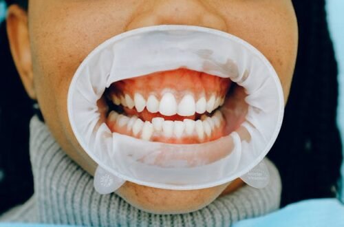 Is Teeth Whitening Safe with Gum Recession?