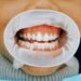 Is Teeth Whitening Safe with Gum Recession?