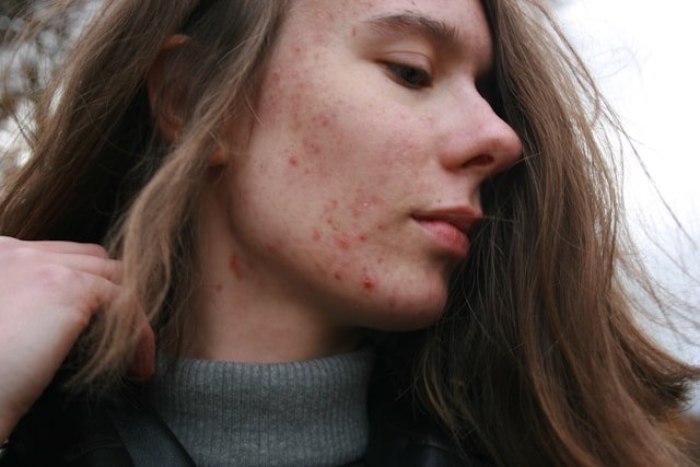 Inositol for Acne: Exploring Its Skin Benefits
